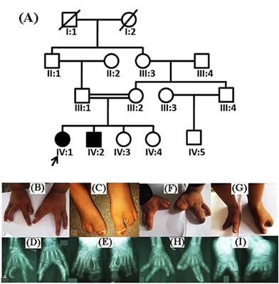 A Novel Homozygous Nonsense Mutation p.Cys366* in the WNT10B Gene Underlying Split-Hand/Split Foot Malformation in a Consanguineous Pakistani Family